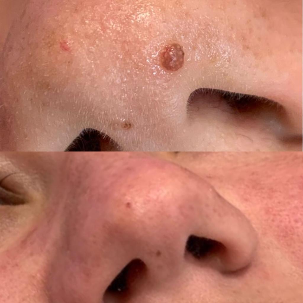 Mole and lesion removal before and after