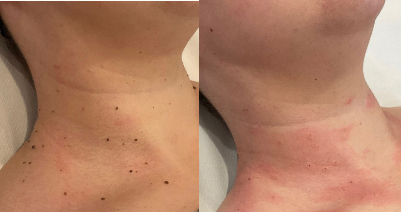 Skin tag and mole removal before and after
